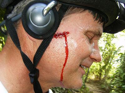 A close-up of a man with a serious facial injury, showing blood trickling down his cheek. He is wearing a helmet and headphones, and appears to be in a natural outdoor setting. The man's expression suggests he is in pain but also somewhat calm. Bonnet Carre Spillway Trail mountain bike trail.