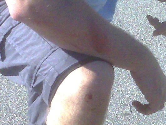 A close-up view of a person's arm resting on their knee, wearing a short-sleeve shirt and shorts. The arm is partially bent, showing skin with a mole on the elbow and faint hair on the forearm. The background consists of a textured surface, possibly pavement. Markham Park mountain bike trail.