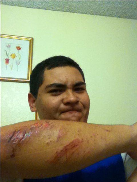 A young person displaying an injured arm with visible scrapes and bruises, while making a facial expression that suggests discomfort or frustration. In the background, there is a framed picture with a floral design on the wall. Sunol Regional Wilderness mountain bike trail.