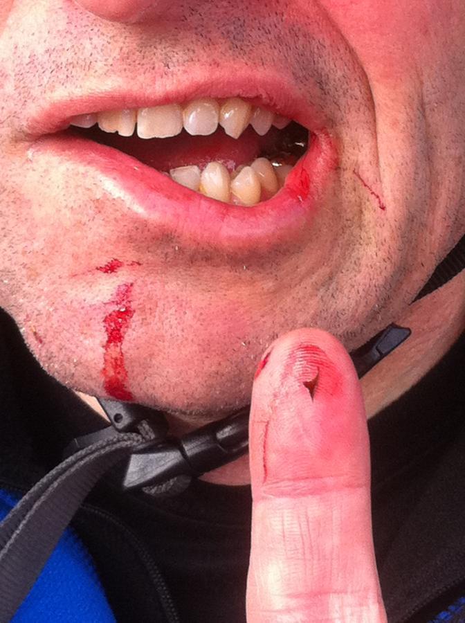 Close-up image of a man's face showing injuries. There are visible cuts and abrasions on his chin and lip, with blood partially smudged on his skin. His finger is pointed towards the camera, also showing a small wound. The man is wearing a helmet strap, indicating he may have been involved in an accident while cycling. Deer Lakes Park mountain bike trail.