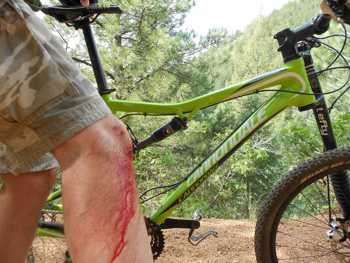 A close-up image of a cyclist's leg showing a scraped knee with fresh blood, alongside a green Cannondale mountain bike parked in a wooded area. Captain Jack's mountain bike trail.