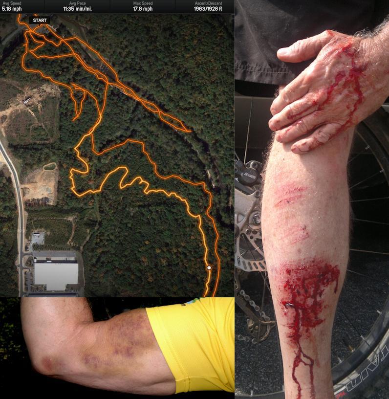 An image showing two main parts: on the left, a GPS trail map with an orange line depicting a cycling route through wooded terrain; on the right, a close-up of a leg with visible injuries, including cuts and bruises, and a hand resting on the leg. The background includes a bicycle wheel, suggesting the injuries may be related to cycling. Taylor Randahl Memorial Mountain Bike Trails At Olde Rope Mill Park mountain bike trail.
