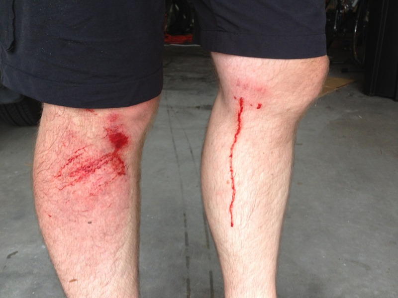 Image of a person's legs showing visible injuries with blood. The skin on both knees appears scraped and bruised, with red marks and lines indicative of recent abrasions. The background is a concrete surface, possibly inside a garage.