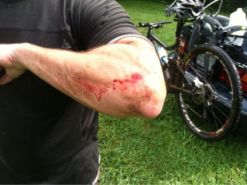 A close-up view of a bloodied and scraped elbow of a person wearing a dark athletic shirt. The arm is slightly bent, revealing dirt and blood on the skin, suggesting an injury. In the background, a bicycle is leaned against a car in a grassy area. Black Mountain mountain bike trail.