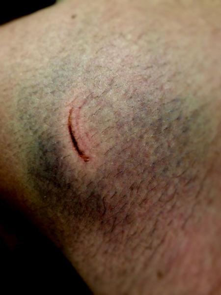 A close-up image of skin showing a healing scar and discoloration, with a small, curved cut and surrounding areas exhibiting bruising. The texture of the skin and hair is visible, emphasizing the details of the injury. Captain Ahab mountain bike trail.