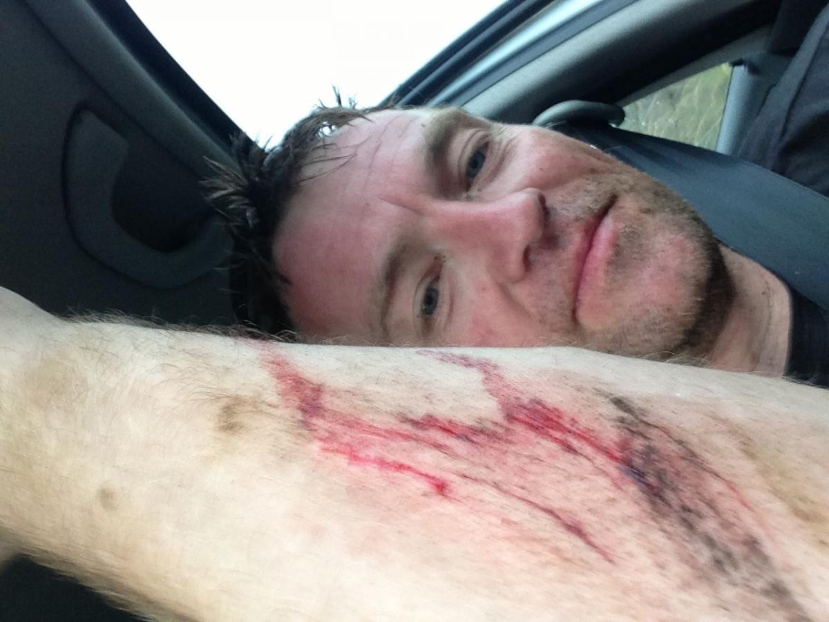 Specialized Stumpjumper FSR: A close-up selfie of a man with a visible injury on his forearm. The skin shows redness and scratches, along with some dirt. The man is looking towards the camera while in a car, with the vehicle's interior visible in the background.
