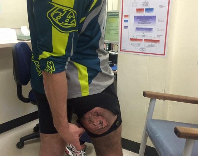 A person in athletic clothing is sitting in a medical facility, showing a significant injury on their knee. The area around the knee appears swollen and discolored, indicating a possible abrasion or laceration. The individual is holding their pants down to reveal the injury, while a medical chart and seating area are visible in the background.