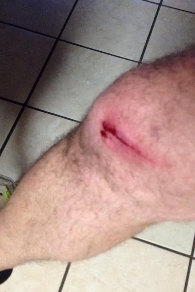 A close-up of a bruised knee with a fresh cut, showing red marks around the wound. The skin appears hairy and the background features tiled flooring. Westside mountain bike trail.