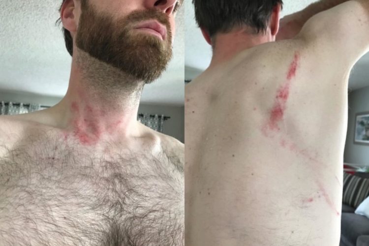 Image showing a close-up of a man's neck and upper back with visible red marks on the skin, indicating possible irritation or injury. The man is shirtless, and the background shows a comfortable indoor setting with soft furnishings.