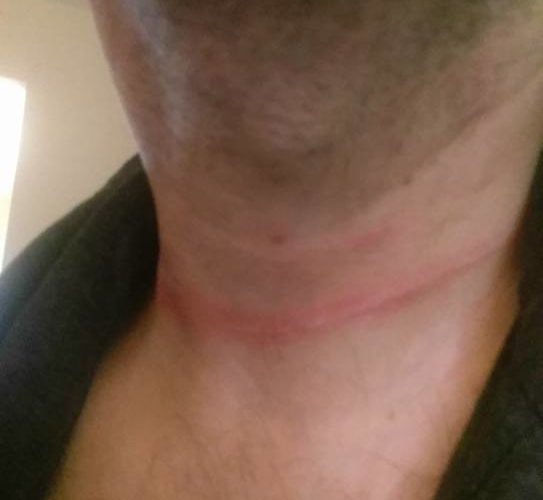 A close-up image of a person's neck showing a noticeable red mark, resembling a line or indentation, around the area just above the collarbone. The skin appears slightly irritated, and the background is softly blurred.