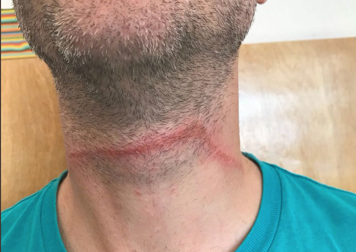 A close-up image of a person's neck showing a noticeable red mark or irritation along the skin, suggesting pressure or friction. The person is wearing a teal shirt, and the background is blurred, revealing a light wooden surface.