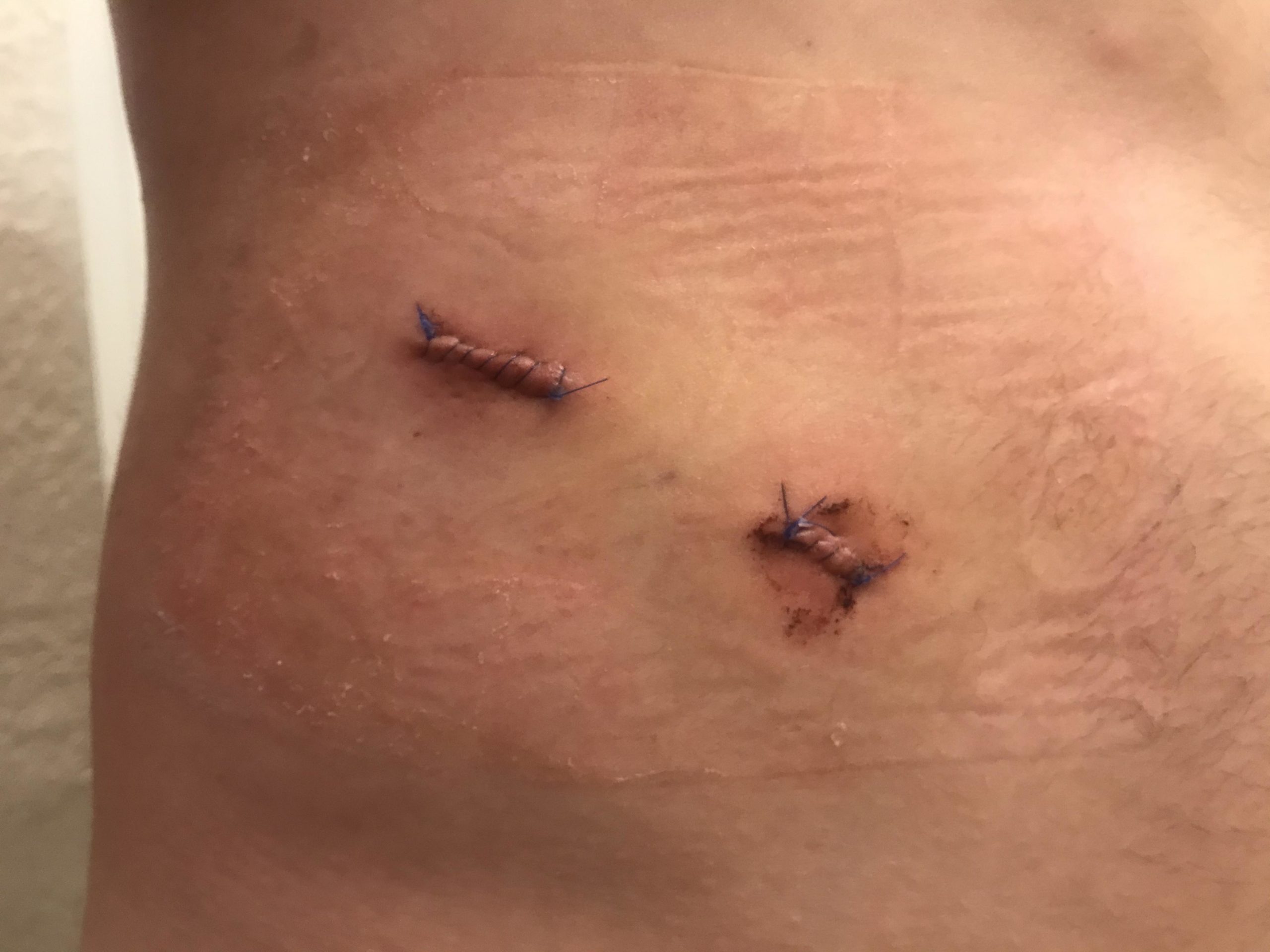 A close-up image of a person's skin showing two surgical stitches on the abdomen, with some discoloration and slight swelling around the stitches. The area appears healing, and there are some lighter skin markings nearby. Franklin Mountain State Park mountain bike trail.